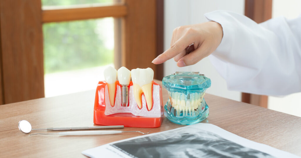 รากฟันเทียม อยู่ได้กี่ปี