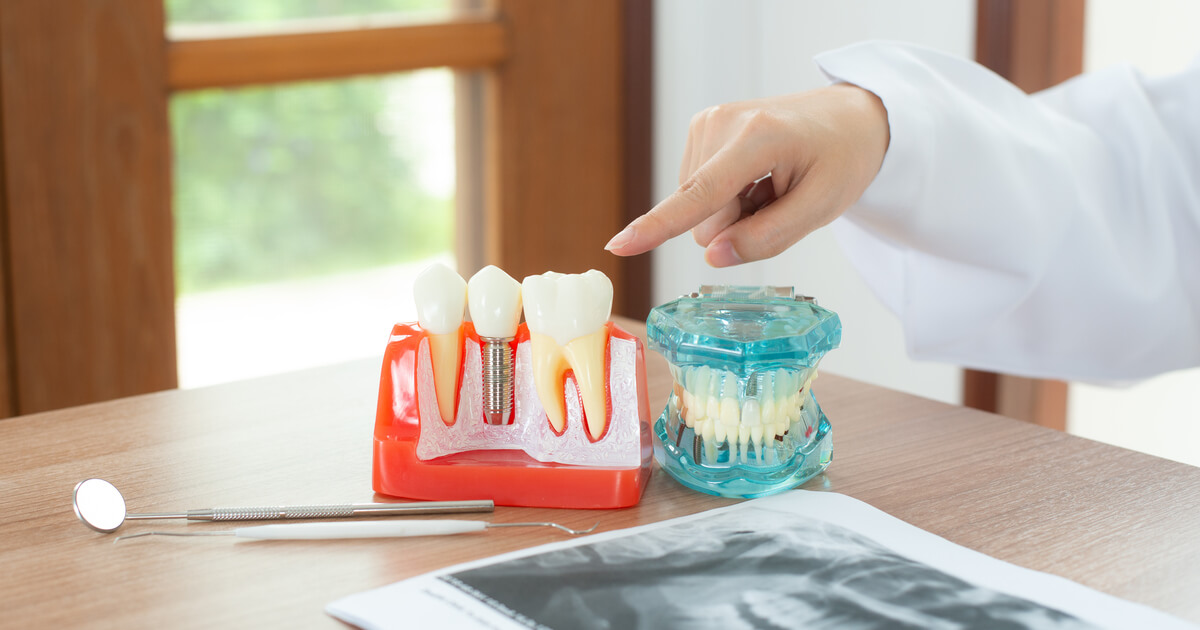 รากฟันเทียม อยู่ได้กี่ปี